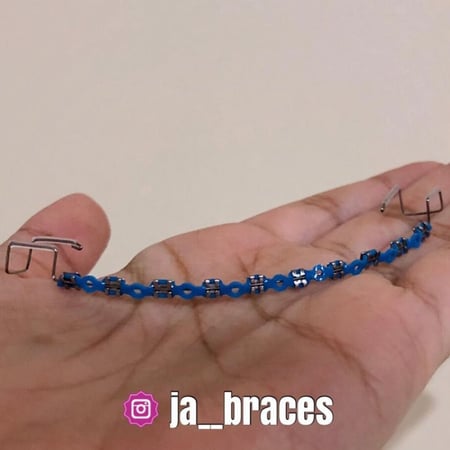 تقويم اسنان زينة (بكج) فك بدون غرا متصل " شامل الشحن "