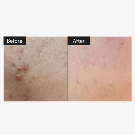 VT - Reedle Shot 300 ريديل شوت 300