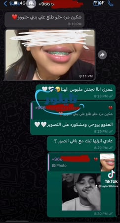تقويم زينه منفصل تركيب غراء ثنين
