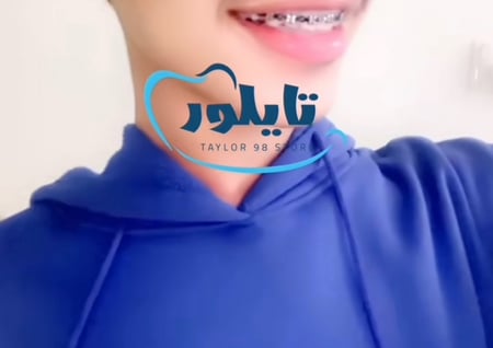 تقويم زينه منفصل تركيب غراء ثنين