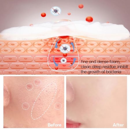 صابون علاج حب الشباب بحمض الساليسيليك vibrant glamour ، صابون تقشير المسام، تنعيم البشرة، رغوة تنظيف الوجه العميق، غسول الجسم، صابون الاستحمام، التحكم في  الزيوت وتقليل البثور والحبوب