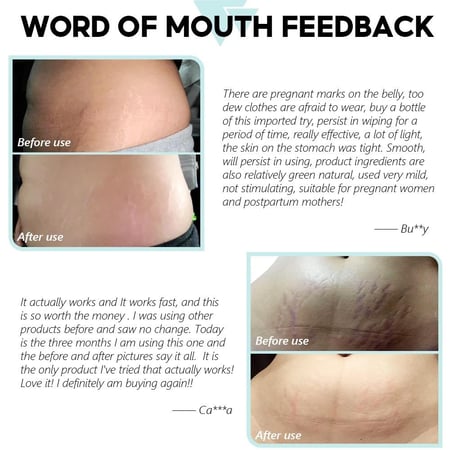 كريم فيتامين e وحمض الاسكوربيك ، هيالورونيك مزيل علامات التمدد إصلاح البشرة  لوشن تبييض وشد مغذي ، كريم مكافحة علامات تمدد الجلد الجديده والقديمة