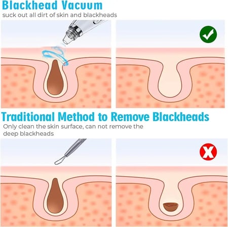 جهاز هيدرافيشال لإزالة الرؤوس السوداء