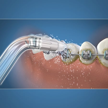 Orthodontic Tips
