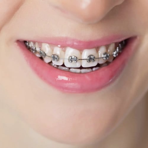 التقويم المعدني للفكين ( الكاش )