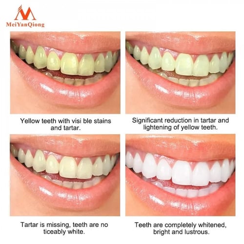 مبيض الاسنان السحري