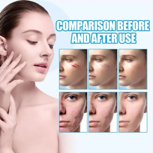 كريم EELHOE لمعالجة الندوب والحروق