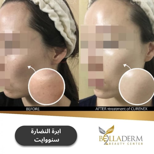 ابرة النضارة سنووايت