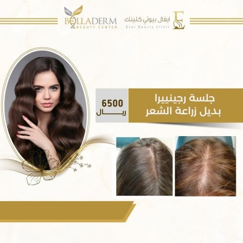 جلسة رجينييرا بديل زراعة الشعر