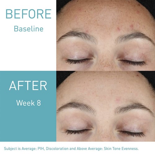 سيرافي، سيروم الريتينول لعلامات ما بعد حب الشباب -...