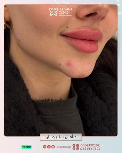 فيلر شفايف - ابتداءً من