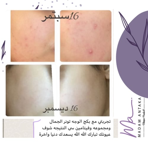 مجموعة فيتامين C للوجه + تونر البشرة