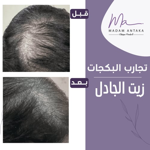 زيت الجادل للشعر 1 + 1 مجانًا