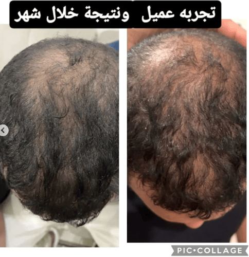 زيت الاول لإنبات الشعر وتكثيفه