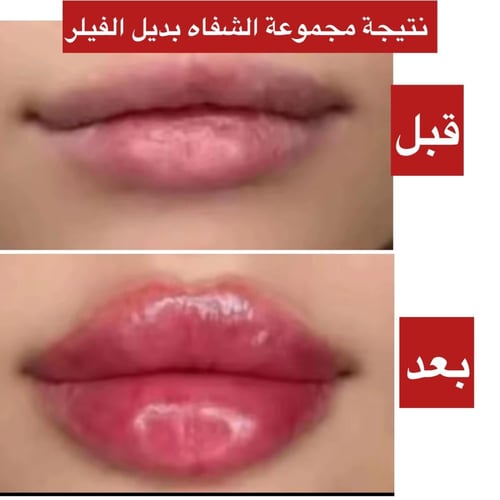 بديل الفيلر لشفايف ممتلئة