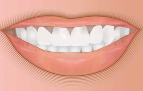 مجموعة قوالب تبييض الأسنان أوباليسنس الأصلية – نكه...