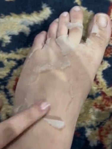 محلول تقشير احماض الفواكة للجسم