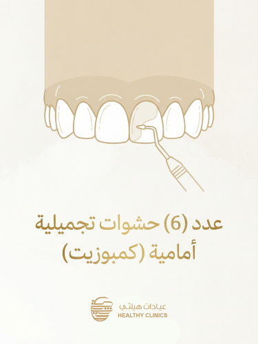 عدد ( 6 ) حشوات تجميلية أمامية ( كمبوزيت )