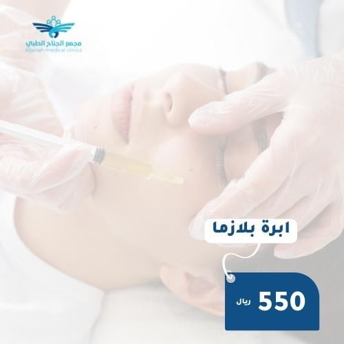 ابرة البلازما