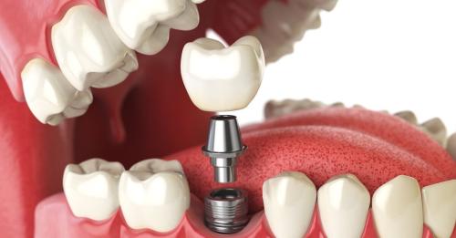 Dental implant