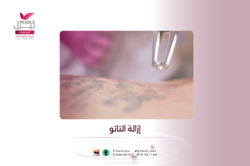 إزالة التاتو (يبدأ من)