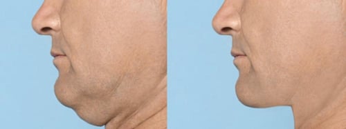 جهاز تدليك قواشا هزاز لشد الجلد وتخفيف تجاعيد البش...