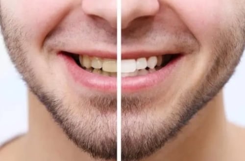 لصقات تبيض الأسنان المطورة 5D