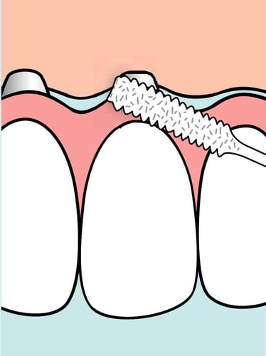 خيط سني عريض للزراعة Implant &brudig floss