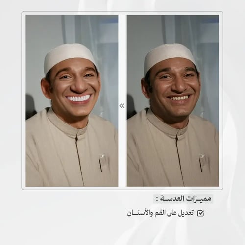 عدسة سناب شات Tooth