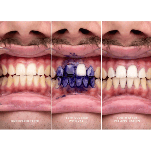 سيروم مصصح لون الاسنان البنفسجي (V34) من هاي سمايل...
