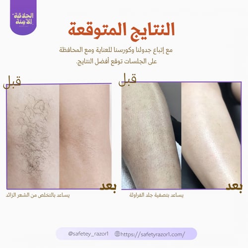 ليزر ايبل لإزالة الشعر IPL -متعدد الألوان