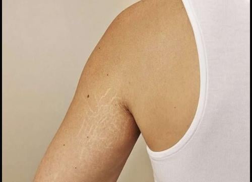 تشققات حول الابطين