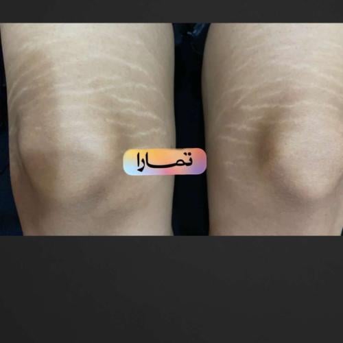 جلسه علاجيه بميزو ترميم للانسجه وجهاز تحفيز الكولا...