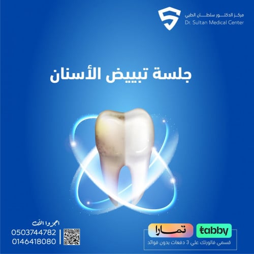 جلسة تبييض الأسنان