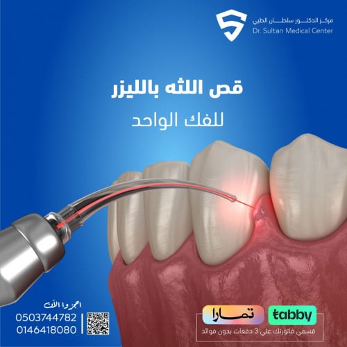 قص اللثه بالليزر