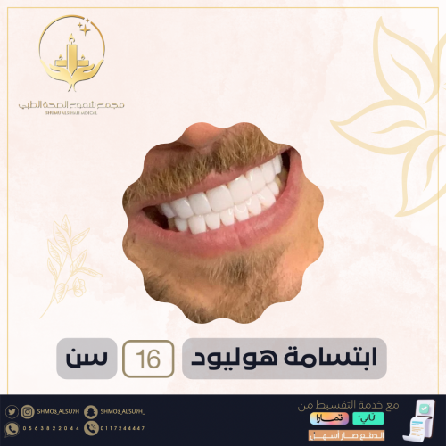 ابتسامه هوليود (16) سن
