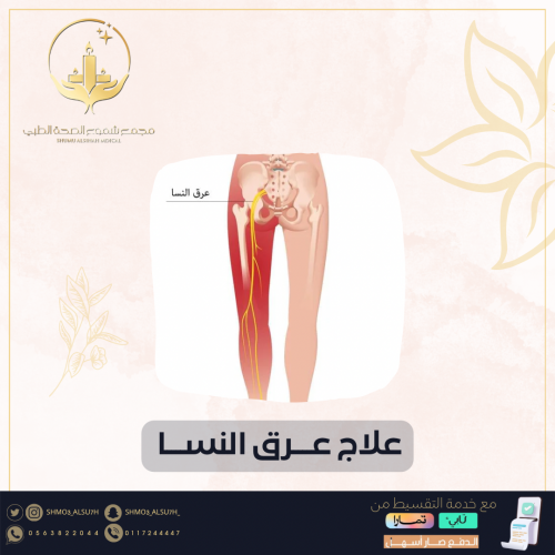 علاج عرق النساء