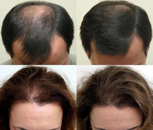 كامينوموتو مسرع نمو الشعر (أكسلريتور الذهبي) - 180...