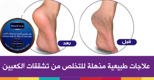 كريم معلاج للبشرة الجافة وتشققات القدم