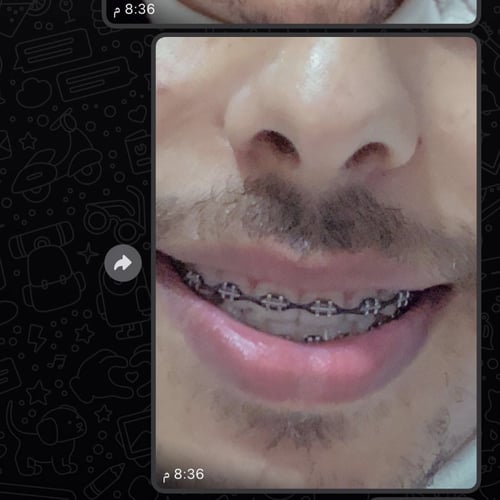 تقويم فك بغرا متصل