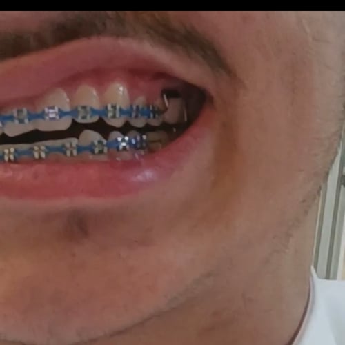 تقويم فكين بدون غرا متصل