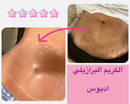 كريم اديوس ADEUS وداعاً للسيلوليت وعلامات التمدد