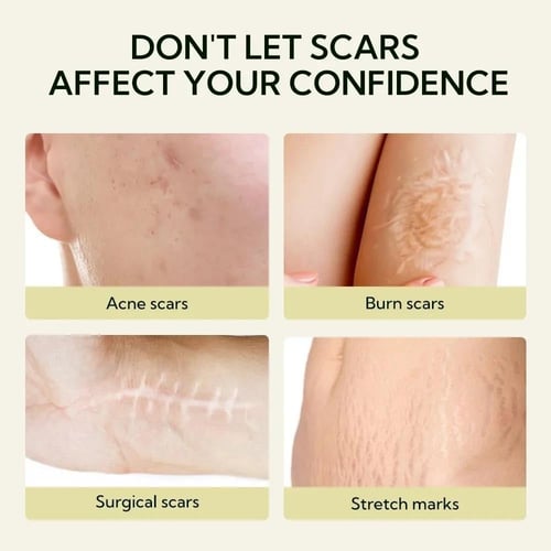كريم إزالة الندبات