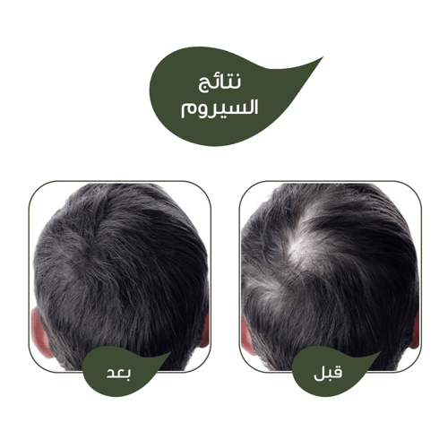 عبوتان سيروم نايلا للشعر و فروة الرأس و اللحية