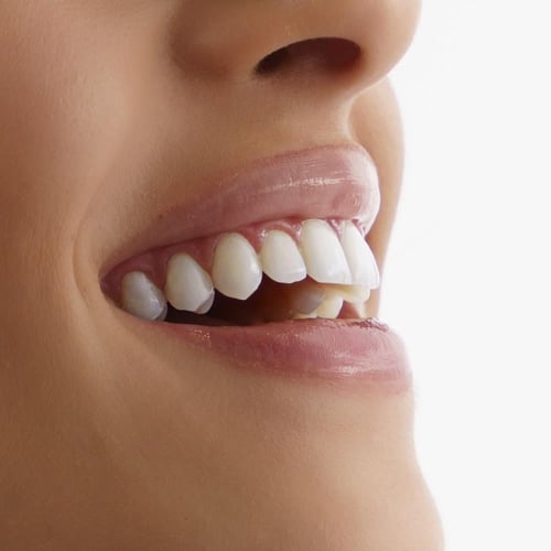 ملمع الأسنان