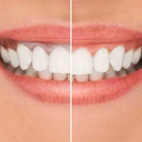 تنظيف الاسنان