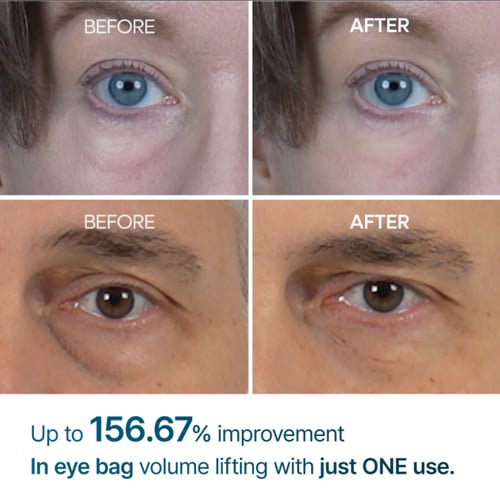 دكتور ميلاكسين‏, Eyephalt ، كريم العينين لإكياس ال...