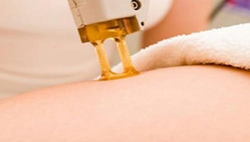 جلستين ليزر جسم كامل مع الرتوش وجلسة تشقير وجه بدو...