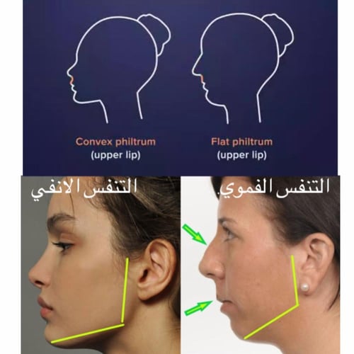 مصحح تنفس لعلاج هضبة الانف وتراجع الفك