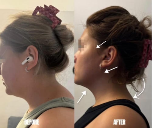 برنامج علاج التحدب بشكل جذري